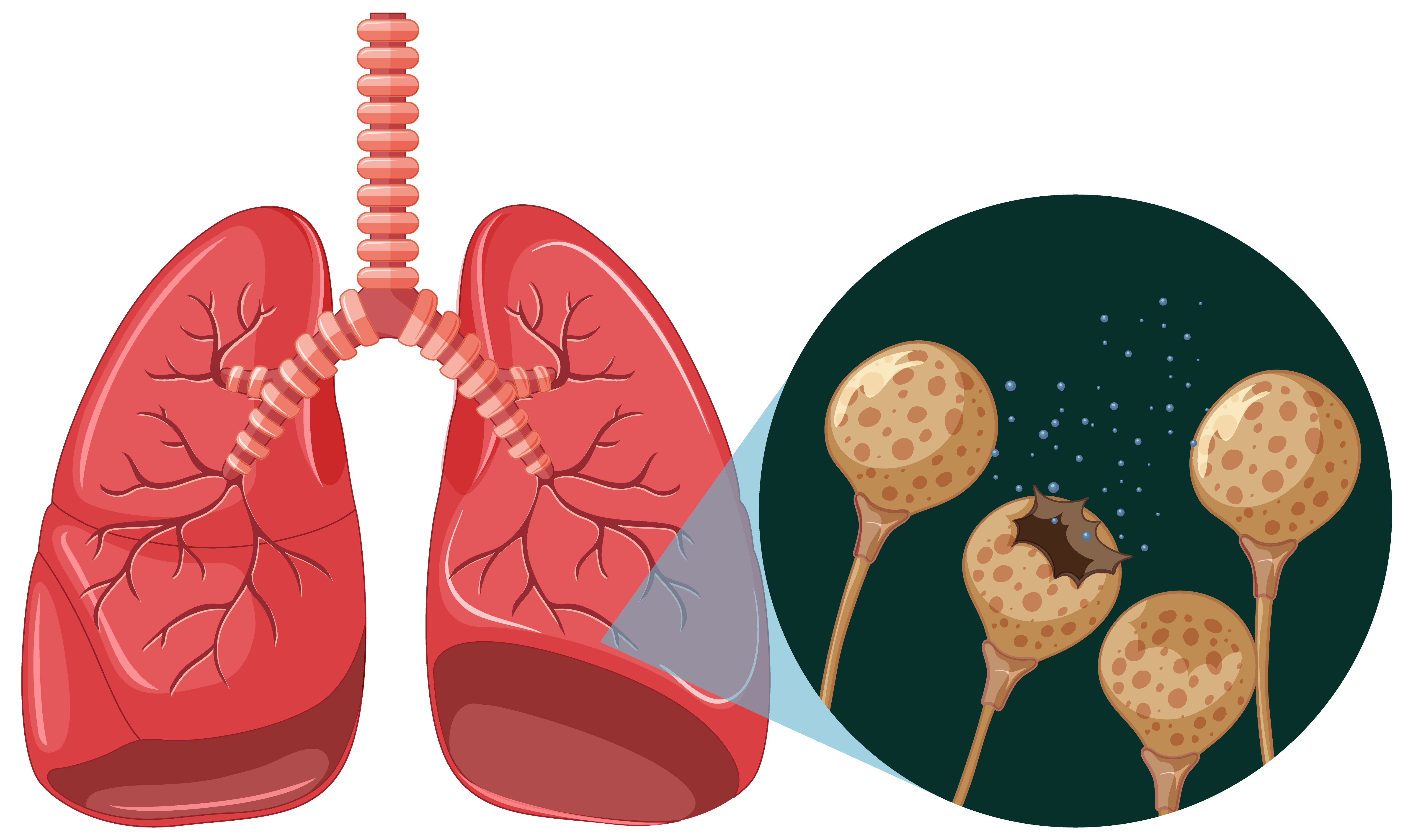 Ilustrasi tuberkulosis. Freepik