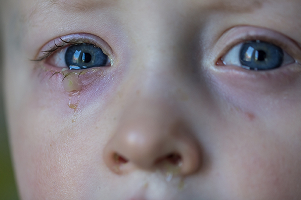 Mata belekan pada anak. Kids Health NZ